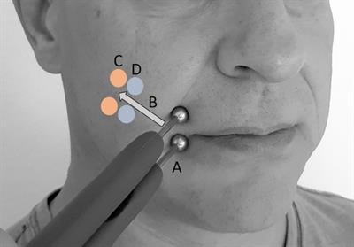 Selective zygomaticus muscle activation by ball electrodes in synkinetically reinnervated patients after facial paralysis